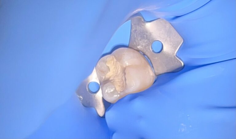 Biodentine – innowacyjny materiał do regeneracji miazgi i odbudowy zębiny