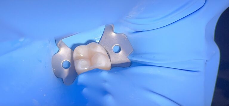 Koferdam – czym jest i jaki ma wpływ na leczenie?