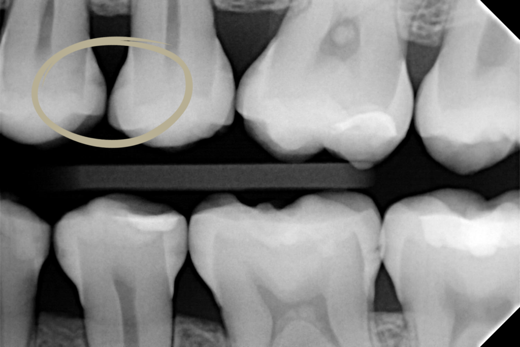 Mikroinwazyjne leczenie zmian próchnicowych – infiltracja Icon 2 Untitled design 1