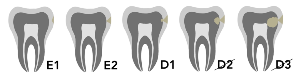Mikroinwazyjne leczenie zmian próchnicowych – infiltracja Icon 3 Zrzut ekranu 2025 02 25 o 10.00.10