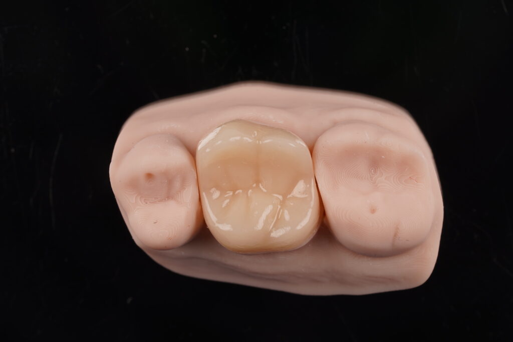 Ząb po leczeniu biologicznym – co dalej? Zalecenia po zastosowaniu Biodentine 3 DSC03261