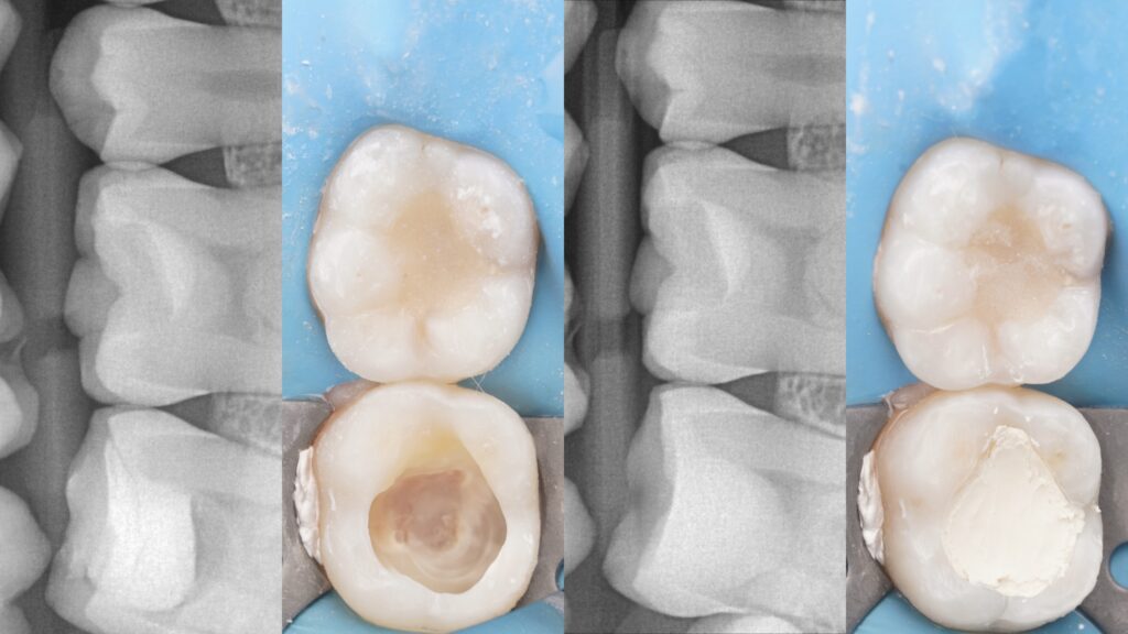 Ząb po leczeniu biologicznym – co dalej? Zalecenia po zastosowaniu Biodentine 2 IMG 5311