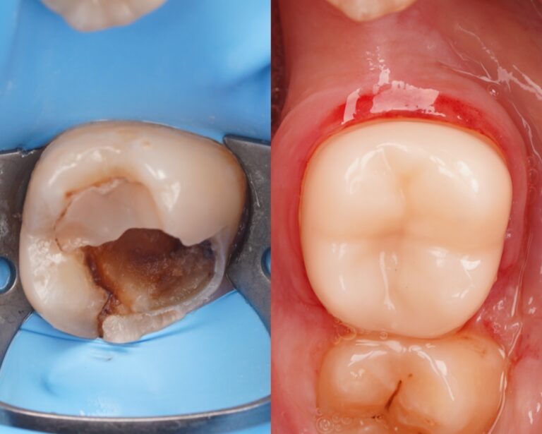 Ząb po leczeniu biologicznym – co dalej? Zalecenia po zastosowaniu Biodentine
