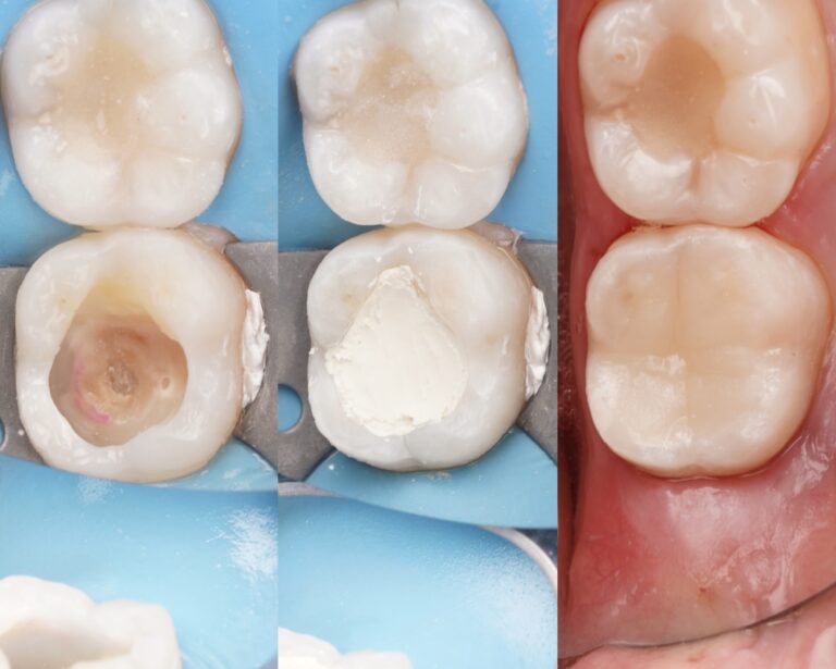 Głęboki ubytek – czy zawsze trzeba leczyć kanałowo? Leczenie biologiczne miazgi i Biodentine