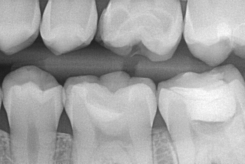 Głęboki ubytek – czy zawsze trzeba leczyć kanałowo? Leczenie biologiczne miazgi i Biodentine 2 rtg